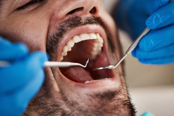 Best Emergency Wisdom Tooth Extraction in Pascagoula, MS